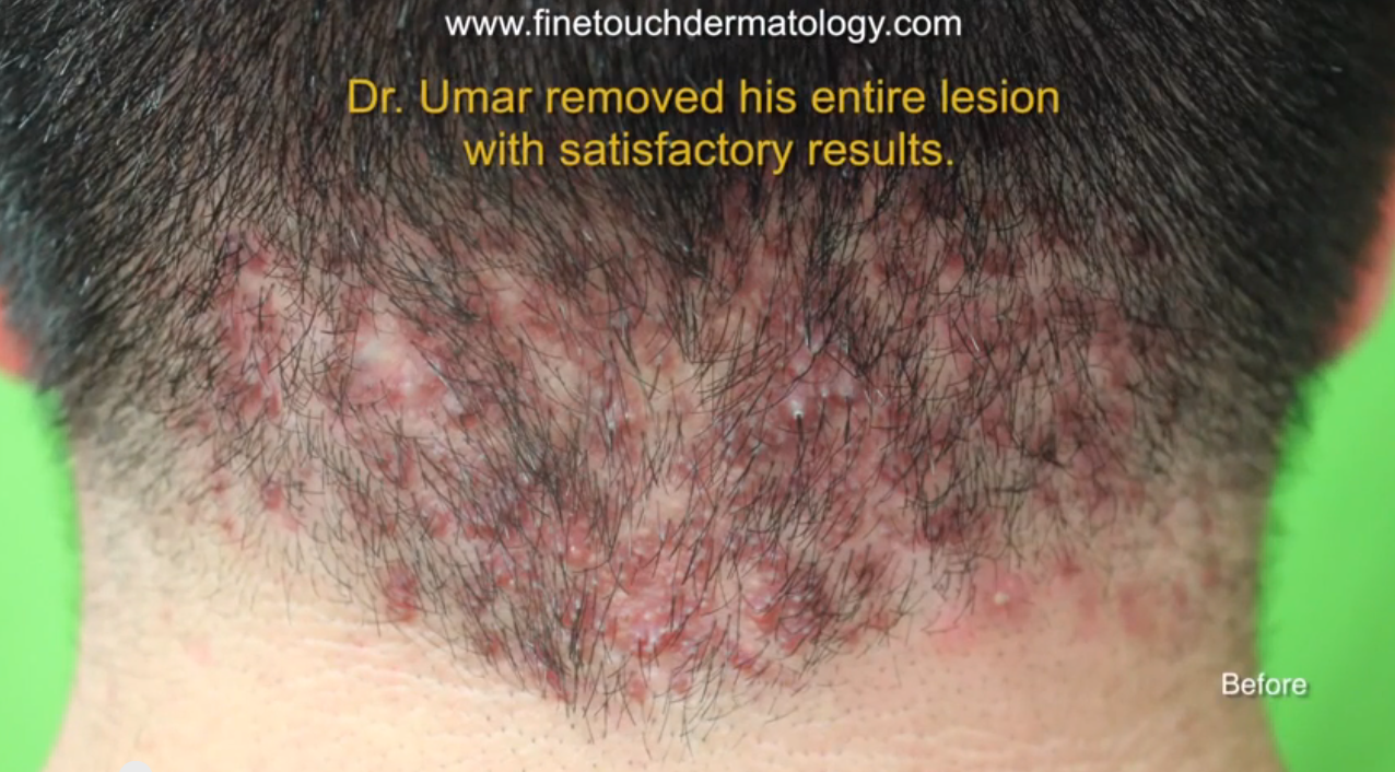 Akn Surgery Results After Scalp Bumps Removal By Dr Umar