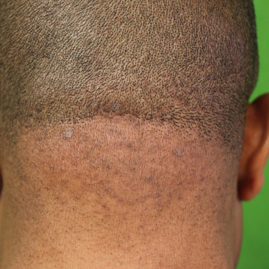 Close up view showing long term remission of papular AKN 2 years after treatment with ND:YAG laser by Dr U