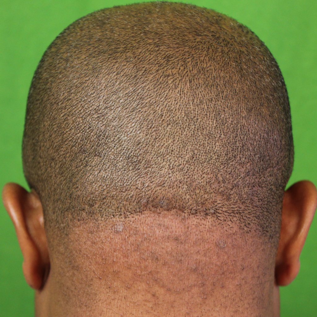 Early stage papular Acne keloidalis nuchae 2 year result after treatment with long pulsed ND YAG Laser by Dr U Early stage papular Acne keloidalis nuchae 2 year result after treatment with long pulsed ND YAG Laser by Dr U