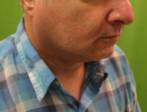 before non-surgical chin augmentation