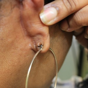 Earlobe keloid scar removal