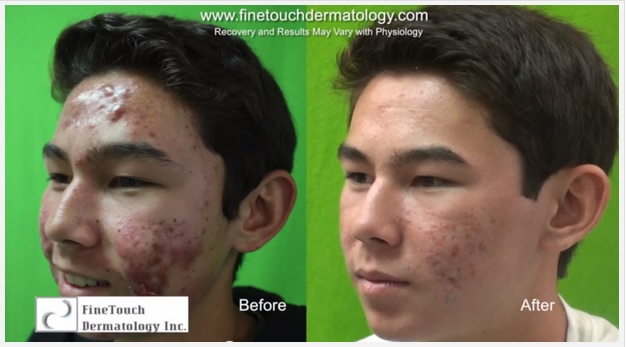 Before & After Laser For Severe Acne Case