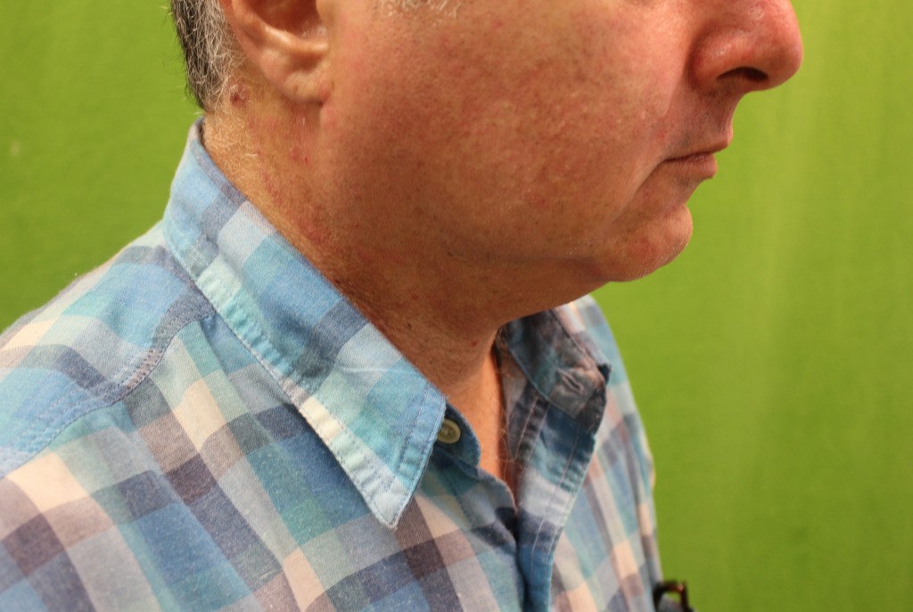 before non-surgical chin augementation with radiesse 