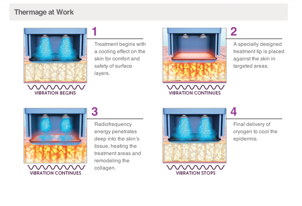 wrinkle-treatment-thermage-123