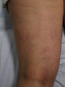 Result of leg vein treatment with Asclera 