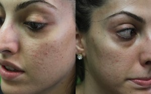 Treatment for Acne| Spectra Laser Results