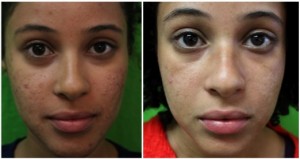 los angeles patient before and after acne scars treatment