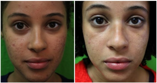 Laser Solutions For Difficult Acne Cases