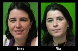 Los Angeles patient before and after acne scar treatment with laser