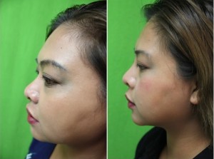 Non surgical nose job with Radiesse