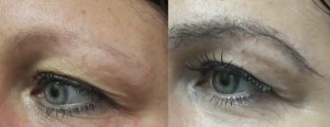 before and after eyebrow hair transplant in a los angeles patient