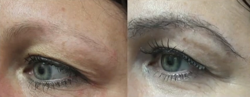 Eyebrow Hair Transplant Results - Los Angeles Patient