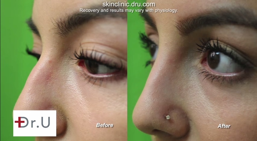 Non-Surgical Nose Job| Radiesse Dermal Filler