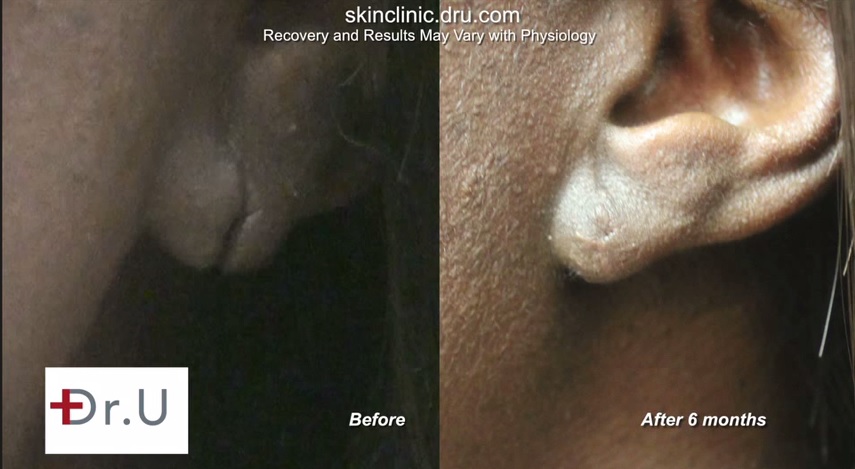 Surgical Repair of Split Earlobes| Before & Afte Photos