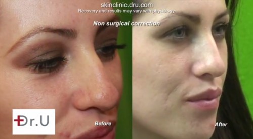 Non-Surgical Nose Job| Three Quarters View of Nose