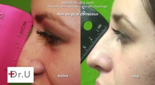 Straightening Nose Bump|Before & After Radiesse Treatment