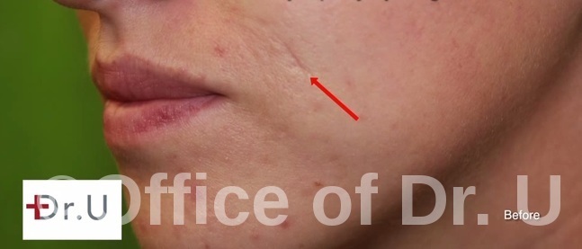 Acne Scar Tissue| Skin Creases Around Mouth