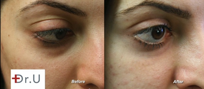 Treating Mild Eye Bags Without Surgery| Patient Results With Radiesse