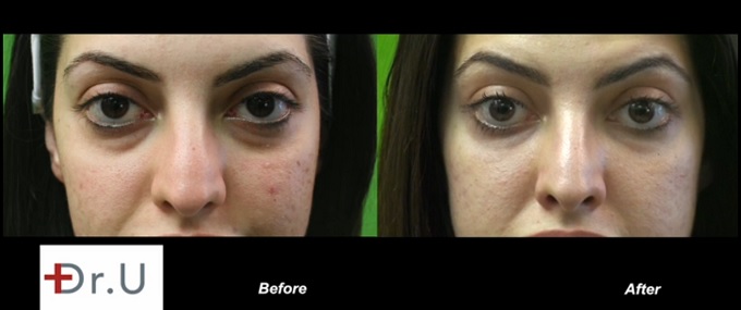 Acne Scarring/Under Eye Circles and Puffiness| Before & After Radiesse