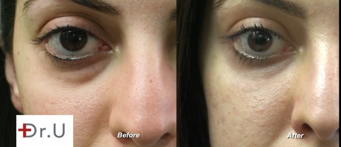 Left Eye View| Undereye Area - Before & After Radiesse Treatment Procedure Left Eye View| Undereye Area - Before & After Radiesse Treatment Procedure