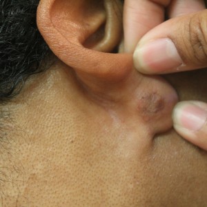 Earlobe keloid scar removal 1 year after surgical removal by Dr U