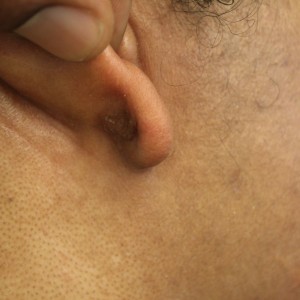 Earlobe keloid scar removal