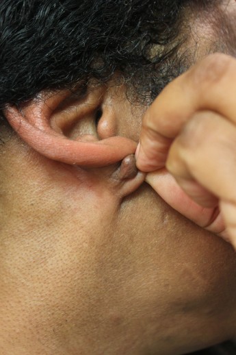 Earlobe Keloid Scar Removal