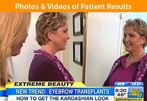 Good Morning America Eyebrow Transplant by Dr. Sanusi Umar